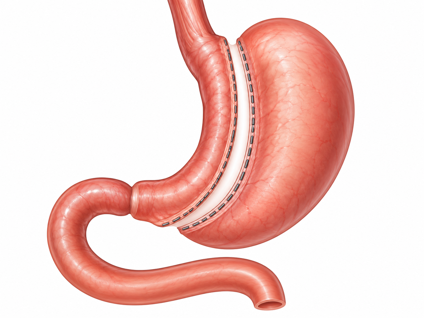 Sleeve gastrectomy diagram