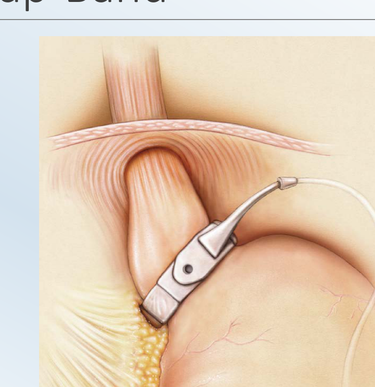 Adjustable gastric band