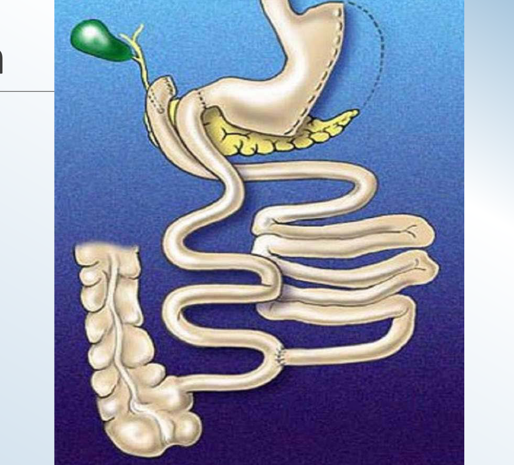 Duodenal switch diagram