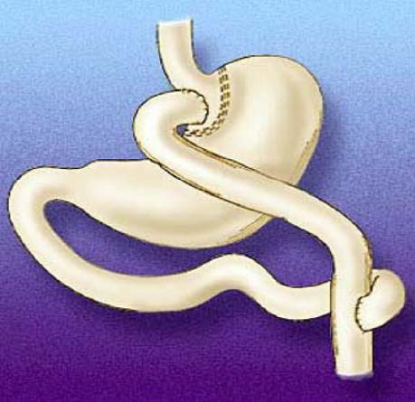 Loop gastric bypass diagram