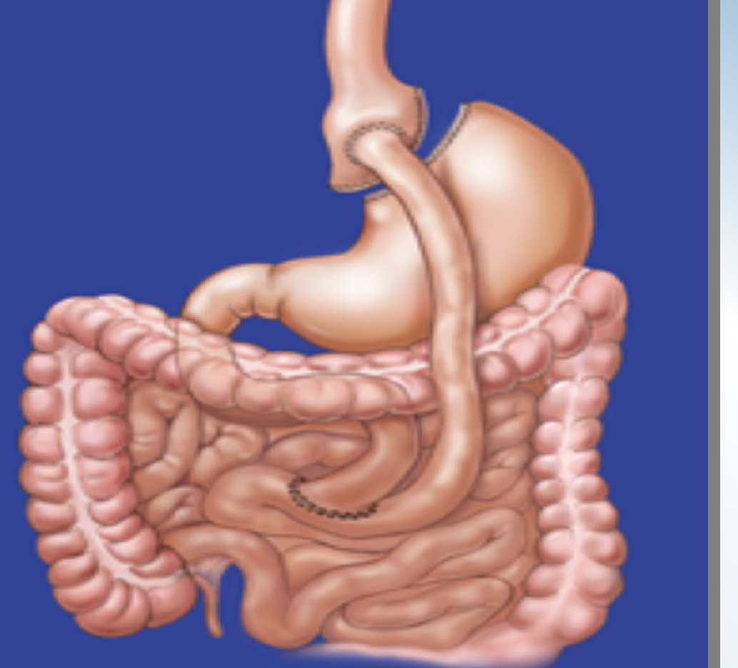 Roux-en-Y gastric bypass diagram