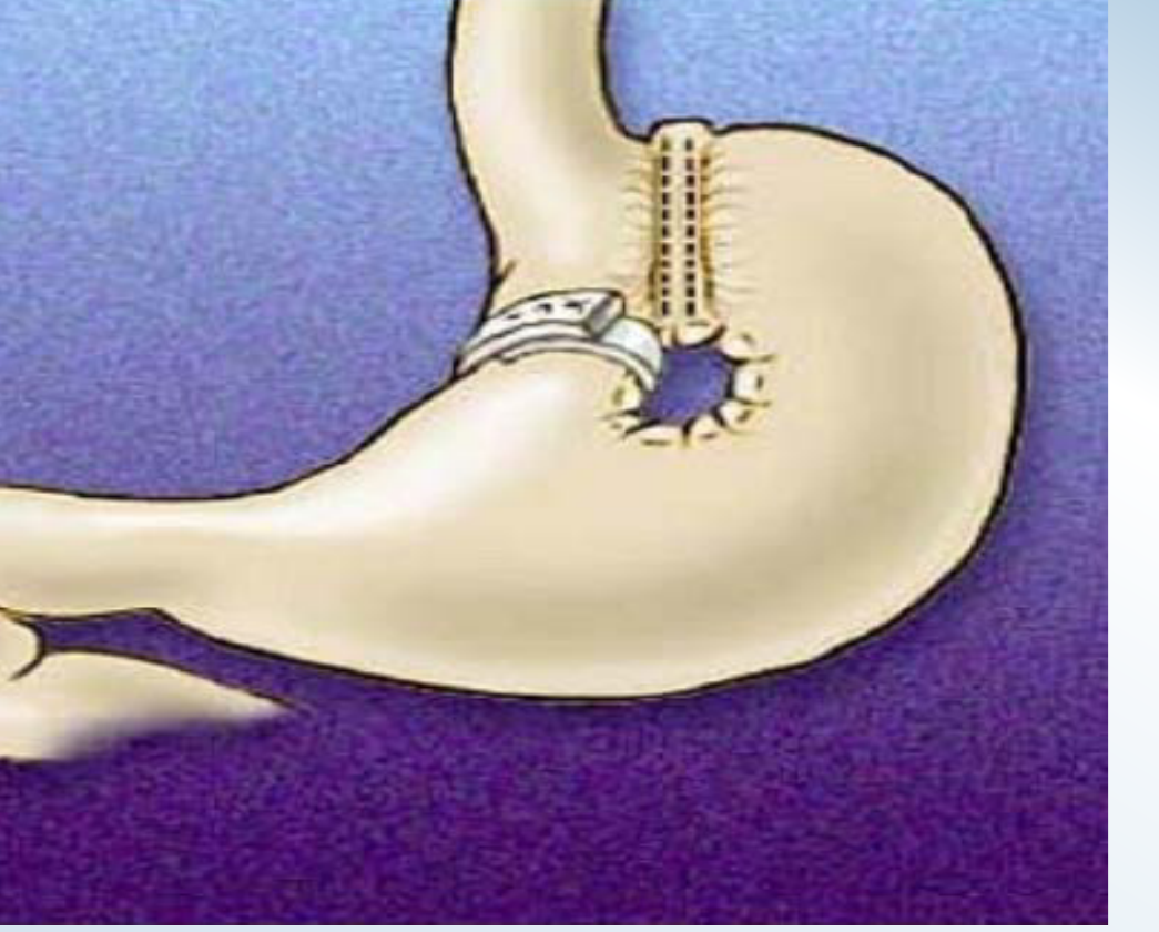 Vertical banded gastroplasty